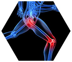 X-Ray of runner demonstrating hip and knee joint pain